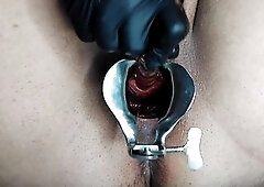 Urethral Gaping With Speculum