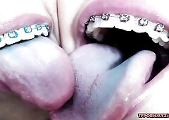 See Youthful brace lesbian babes tounge giving a kiss on now! - Braces Teen, Lesbo Giving A Kiss, Honey Porn 2 cute lesbos who wearing blaces are toun