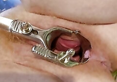 Need larger speculum